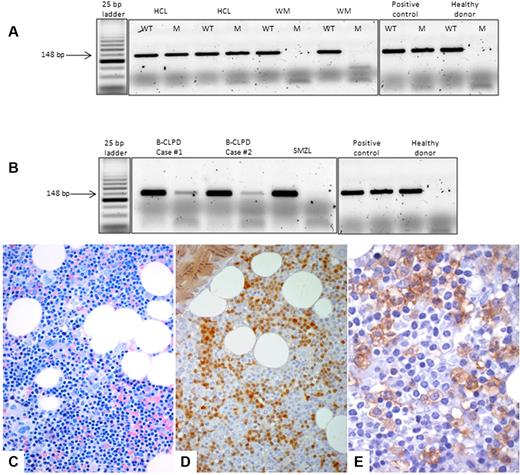Figure 1. ASO-PCR assay and bone marrow histology. Top, ASO-PCR assay. PCR products were separated on 3% agarose gel electrophoresis, and for each sample, the wild-type (WT) and the mutant (M) allele were amplified. (A) HCL samples presented the BRAF V600E mutation, whereas the MW cases did not present the mutant allele. (B) Although B-CLPD cases 1 and 2 presented both the wild-type and the mutant allele, the SMZL case did not present the BRAF V600E mutation. An HCL sample with an heterozygous BRAF V600E mutation was used as a positive control, and a healthy donor was used as a negative control. Bottom, BM histology of case 1. (C) On BM biopsy, an abundant (60%) lymphoid infiltrate was observed with interstitial pattern and composed by small lymphocyte-like, centrocyte-like cells, without the typical morphology of hairy cells (Giemsa staining, ×40). (D) By immunophenotyping, either on histologic sections (here) or by flow cytometry on BM aspirate (Table 1), the only similarity between this case and HCL was the expression of cyclin D1/bcl1 oncoprotein (streptavidin-biotic-peroxidase complex method/SABC, DAB chromogen, ×40). (E) ANXA-1, the most specific marker of HCL, was negative on the lymphoid population, and only was expressed by myeloid precursors, which serve as internal control (SABC, DAB chromogen, ×60).