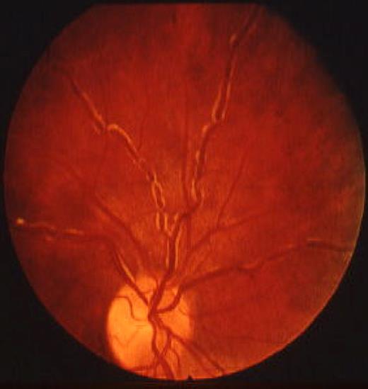 Figure 1. Funduscopic appearance of patient with WM and mixed cryoglobulinemia. Note the marked retinal venous engorgement and “sausaging.” The white material at the edge of the veins may be cryoglobulin.12,20 Reprinted from Stone with permission.12