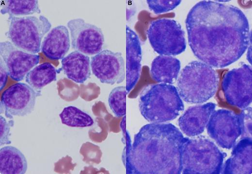 An 82-year-old man had a pleural effusion but no other clinical symptoms. He had no hepatosplenomegaly or lymphadenopathy. His leukocyte count was 45 100/uL with 93% mature-appearing lymphocytes. The hemoglobin and platelet counts were normal. Bone marrow examination showed mature lymphocytes (83%), positive for CD11b/c, CD13, CD19, CD20, and CD25, but negative for CD5 and CD23. The pleural effusion showed morphologically and phenotypically similar lymphocytes (panel A). A diagnosis of mature, low-grade B-cell malignancy was made. He was treated with fludarabine and rituximab; however, the pleural effusion worsened over the next 3 months. Repeat pleural effusion showed large cells with deeply basophilic cytoplasm and vacuoles (panel B), positive for CD38, CD138, and CD56, but negative for CD19 and CD20. Other intensive chemotherapy regimens were tried without success. He died of respiratory failure because of uncontrollable bilateral pleural effusion several months later. / The original lymphocytic population that was present in the pleural effusion was not detected subsequently. Instead, immature plasma cells were noted both by morphology and cell markers. A histologic transformation from lymphocytic lymphoma to plasmablastic lymphoma was considered as well as a reactive plasma cell population. The clinical deterioration supported malignancy.