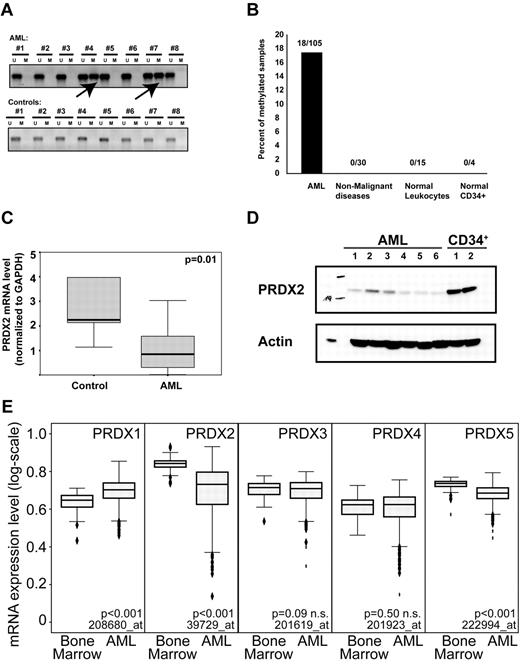 Figure 2. DNA promoter hypermethylation contributes to the epigenetic silencing of the PRDX2 gene in AML. (A) MSP shows promoter methylation in patients with AML no. 4 and no. 7. In total, 105 AML samples and 49 controls (normal BM, nonmalignant controls) were analyzed by MSP. (B) Overall, 18% of the AML samples was methylated at the PRDX2 promoter as analyzed by MSP. No DNA methylation was detected in nonleukemic controls. (C) Low expression of PRDX2 mRNA transcript in AML (n = 61) compared with normal BM specimens (n = 15) as assessed by real-time RT-PCR analysis on BM specimens obtained from patients with AML and healthy persons. Relative gene expression levels were calculated with the use of standard curves with GAPDH being used as internal standard. Statistical analyses were done with SPSS 12.0 (SPSS Inc), and the nonparametric Mann-Whitney U test was used to compare the expression levels of PRDX2 between AML and controls (P = .01, Mann-Whitney U test). Primer sequences are given in the supplemental information for methods. (D) Western blot analysis shows reduction of PRDX2 protein levels in primary AML samples compared with normal CD34+ cells. Actin was used as a loading control. (E) The mRNA expression of different PRDX genes was analyzed in a published microarray dataset with 542 AML and 73 nonleukemic BM specimens. P values were calculated with the Mann-Whitney U test. The Affymetrix probe IDs are indicated as well. Two probes of similar quality were present for each PRDX3 and PRDX5. Both led to similar results so only one each was shown in the figure.