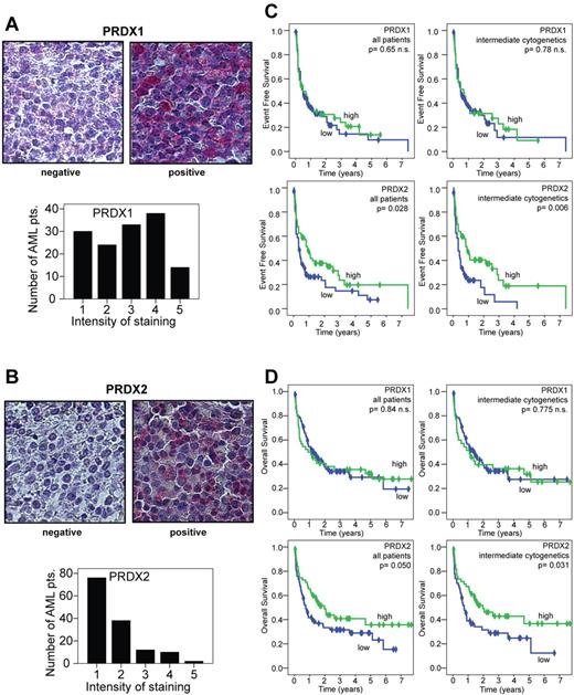Figure 3. Low expression of PRDX2 protein in AML blasts is associated with a poor prognosis. (A) Intensity of PRDX1 staining in tissue arrays from AML BM biopsies. PRDX1 low staining (grade 1-3; left) and positive (grade 4-5; right). AML BM biopsies were analyzed by IHC. (B) Intensity of PRDX2 staining in tissue arrays from AML BM biopsies. PRDX2 low/negative (left) and high (right). AML BM biopsies were analyzed by IHC. Pictures were taken on an Axio Imager M1 (Carl Zeiss Imaging Systems) with a 63×/1.4 oil objective at room temperature and processed by AxioVision Release 4.5 (Carl Zeiss Imaging Systems). (C) Kaplan-Meier plots were generated to compare EFS among patients with AML with low or high expression of peroxiredoxins. Results are indicated for the entire patient cohort and for the more homogenous group with intermediate cytogenetics. Patients whose blasts expressed low levels of PRDX2 only experienced worse EFS compared with patients with AML with high expression of PRDX2 (P = .028, log-rank test). In patients with intermediate cytogenetics, low expression of PRDX2 was associated with poor EFS (P = .006). PRDX1 expression levels did not correlate with EFS. (D) Analyses of OS with regard to peroxiredoxin repression. The Kaplan-Meir plots indicate that patients with AML with low PRDX2 expression in leukemic blasts show decreased OS compared with patients with AML with high expressing blasts (P = .050). In patients with intermediate cytogenetics a close association between low expression of PRDX2 in leukemic blasts and poor OS was found (P = .031). PRDX1 expression did not correlate with OS.