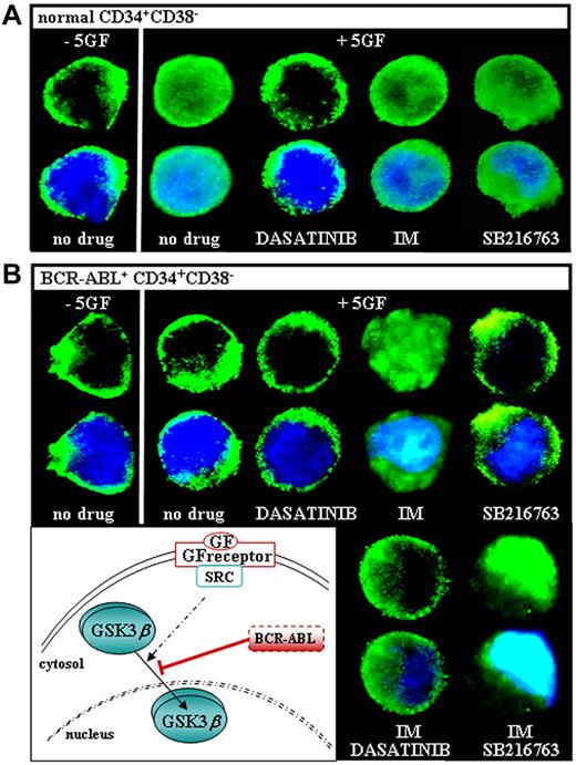 Figure 3. GSK3β localization in CML CP progenitors in response to GF stimulation and IM. Freshly isolated normal (A) and CML (B) CD34+CD38− cells were cultured in the absence of serum and cytokines (−5GF) for 6 hours, and then exposed for 2 hours to a 5 GF cocktail (+5GF) in the absence (no drug) or presence of dasatinib (0.15μM) and/or IM (1μM), SB216763 (5μM) alone, or the combination of IM and SB216763. Each confocal image is representative of 3 immunofluorescence analyses of GSK3β using an anti-GSK3β Alexa Fluor 488–conjugated Ab (top panels). Overlap of GSK3β fluorescence signal and 4′,6-diamidino-2-phenylindole staining (bottom panels) is also shown (magnification, 60×). The depicted model illustrates that the shuttling of GSK3β in and out of the nucleus of normal cells is promoted by a GF-receptor engagement of SRC tyrosine kinases, because it is selectively inhibited by dasatinib but not imatinib. GSK3β is mislocalized to the cytoplasm of GF-stimulated CML cells and relocated to the nucleus after IM treatment, indicating a BCR-ABL kinase–dependent regulation.
