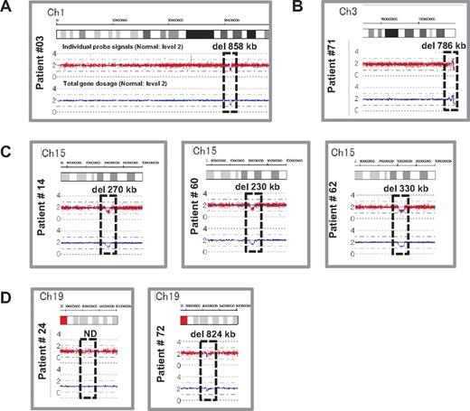 Figure 3. Results of SNP genomic microarray (SNP-chip) analysis. Genomic DNA of 27 Japanese DBA patients with unknown mutations was examined using a SNP array. Six patients had large deletions in their chromosome (ch), which included one DBA-responsible gene. Patient 3 has a large deletion in ch1 (A), patient 71 has a deletion in ch3 (B), patients 14, 60, and 62 have deletions in ch15 (C), and patient 72 has a deletion in ch19 (D).