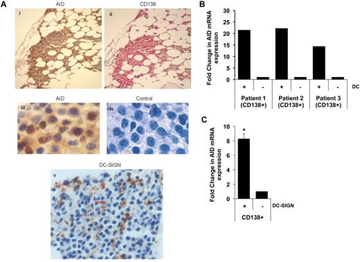 Figure 2. Expression and DC-mediated induction of AID in primary MM cells. (A) IHC detection of AID expression in primary MM cells. Serial sections were stained with anti-AID (i) and anti-CD138 Ab (ii). Panels iii and iv show higher magnification (×40) images. Panel v shows the presence of DC-SIGN+ DCs interdigitating within tumor cells in the same marrow. (B) Purified CD138+ MM cells were cultured alone or with DCs as in Figure 1A. After overnight culture, tumor cells were re-isolated and analyzed for the expression of AID. Data are representative of ≥ 3 similar experiments. (C) DC-SIGN+ subpopulation of the DCs were isolated from the BM and cocultured with CD138+ tumor cells. After overnight culture, tumor cells were re-isolated and analyzed for the AID expression. Data are representative of 2 independent experiments.