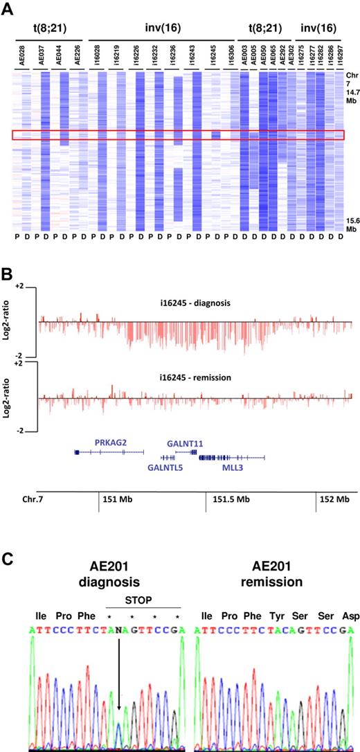 Figure 2. Deletions of 7q36.1 involving MLL3. (A) Log2 ratio SNP copy number data in 23 cases at diagnosis with focal or more extensive deletions (P indicates paired normal; and D, diagnosis). (B) Minimally deleted region in 7q36.1 (647 Kb in size) defined by case i16245 containing the 4 genes PRKAG2, GALNTL5, GALNTL11, and MLL3. Each vertical red line represents the genomic position and log2 ratio copy number of an individual marker. (C) Sequencing of MLL3 showing a truncating mutation leading to a premature stop codon in a single case (AE201) without del(7q).