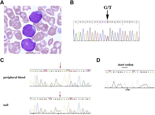 Figure 1. TRIB1 R107L mutation identified in DS-related leukemias. (A) Giemsa staining of the case 84 peripheral blood smear diagnosed as AMKL. The image was acquired using a BX40 microscope equipped with a 100×/1.30 NA oil objective (Olympus) and a C-4040 digital camera (Olympus). (B) Fluorescent dye sequencing chromatographs of TRIB1 genotyping by direct sequencing of the case 84 using a cDNA sample as a template. The vertical arrow indicates mixed G and T signals at codon 107. (C) Fluorescent dye sequencing chromatographs of TRIB1 of peripheral blood leukocytes (top) or nail (bottom) in the same case at the complete remission stage. The red arrows indicate that the mutation remains in leukocytes but not in nail. The reverse strand sequences are shown. (D) GATA1 sequence. The start codon that was mutated in AMKL7 is normal in the peripheral blood leukocytes at the remission stage.