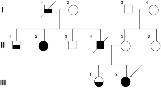 Figure 1. The family pedigree. Squares indicate males and circles indicate females. Open symbols represent unaffected persons, half-filled symbols represent persons affected by thrombocytopenia, and closed symbols represent persons affected by FPD who developed MDS/AML. The proband (III-2) is indicated by an arrow.