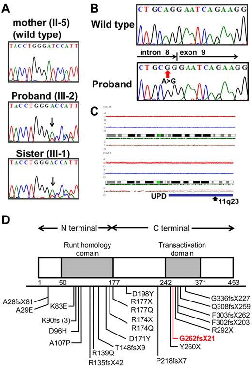 Figure 2. Mutation analysis of RUNX1 and CBL genes in the pedigree. (A) Direct sequencing analysis of affected patients (III-1, III-2) and an unaffected family member (II-5) is shown. Arrow indicates a one-base deletion of adenine. (B) Mutated CBL is shown in the proband. (C) Identification of acquired uniparental disomy of 11q in the proband. Total copy number (tCN; red plot) is shown above the cytoband, and the results of allele-specific copy number analysis with anonymous references (AsCNAR) plots are shown below the cytoband. Larger allele is presented by a red line, and the smaller allele is presented by a blue line. Allele-specific analysis showed 11q-aUPD (blue line), which contained the CBL region (arrow). (D) Schematic representation of wild-type and mutated RUNX1. The affected RUNX1 is truncated at the C terminus of the transactivation domain (TAD). Part of TAD is lacking in this proband (red line).
