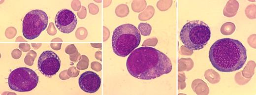 A 60-year-old man presented with an IgG κ monoclonal paraprotein (50 g/L) and pancytopenia (hemoglobin 77 g/L, white blood count 1.1 × 109/L, platelets 75 × 109/L). The bone marrow was hypocellular, lacking in normal hematopoiesis, but contained plasma cells. A diagnosis of multiple myeloma was made and the patient was treated with vincristine, doxorubicin, and dexamethasone, followed by an autologous stem cell transplant. The paraprotein disappeared after treatment. Three years later, the patient became pancytopenic once again. Bone marrow aspirate showed hypocellularity with 95% of the cells appearing with variable size, with round, often eccentric nuclei, chromatin of variable density, abundant basophilic cytoplasm, and occasional fine vacuoles (see figures). The morphology was compatible with early plasma cells and/or erythroid precursors. The continued absence of the paraprotein suggested remission of myeloma or nonsecretory plasma cells. Flow cytometric immunophenotyping showed low expression of CD45 and CD36, glycophorin positivity, and CD138 negativity that suggested erythroid lineage and a diagnosis of pure erythroid leukemia. Multiple karyotypic abnormalities were present. The patient rapidly deteriorated and died shortly after. / Cases of multiple myeloma can evolve into leukemia. In most of these instances, acute nonlymphocytic leukemia or myelodysplasia occurs. Pure erythroid leukemia is an uncommon disease and its evolution from multiple myeloma is distinctly unusual. In this case, the morphologic similarity of plasma/erythroid cells was elucidated by immunophenotyping.