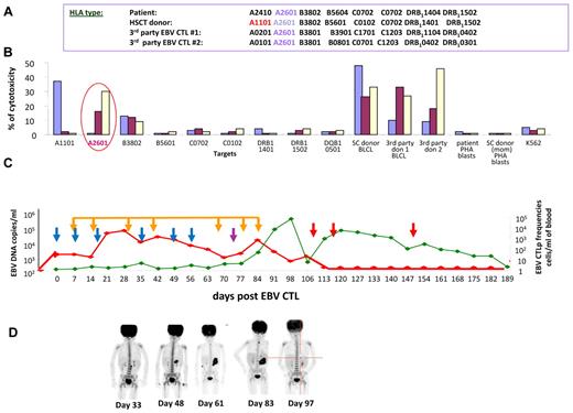 Figure 4. Basis for nonresponse: donor-derived EBV-specific T cells did not recognize host origin EBV-LPD (patient 8). (A) HLA type of the stem cell donor (mother), third-party EBV-CTLs donor 1, and third-party EBV-CTL donor 2. (B) HLA-restriction analysis of EBV-specific T cells generated from the HSCT donor (mother; blue bars) or from the third-party donor 1 (brown bars) or third-party donor 2 (yellow bars) tested in a Cr51-release assay against a panel of allogeneic EBV-BLCLs, each matching 1 HLA allele of each of the T-cell donors' HLA types. (C) Monitoring of the EBV DNA levels (red line) and EBV-specific T cells (green line) after infusions of EBV-CTLs derived from the stem cell donor (blue arrows), third-party donor 1 (purple arrow), and third-party donor 2 (red arrows) at the doses of 1 × 106 cells/kg/infusion. Treatment with Rituxan (375mg/m2; orange arrows), as well as injections of EBV-CTLs derived from the HSCT donor that were restricted by the donor-unique HLA A1101 allele, did not affect high levels EBV DNA, whereas the administration of the EBV-specific T cells from the third-party donors 1 and 2, both restricted by the A2601 HLA allele presented on the EBV+ tumor cells of patient origin, resulted in a rapid decrease of the EBV DNA in the circulation. (D) Sequential PET scans demonstrating no response to the transplant donor's T cells with rapid development of an EBV lymphoma of the gastric wall and adjacent lymph nodes. By 3 weeks after the first infusion of third-party T cells (d97), gastric lymphoma was no longer detected.