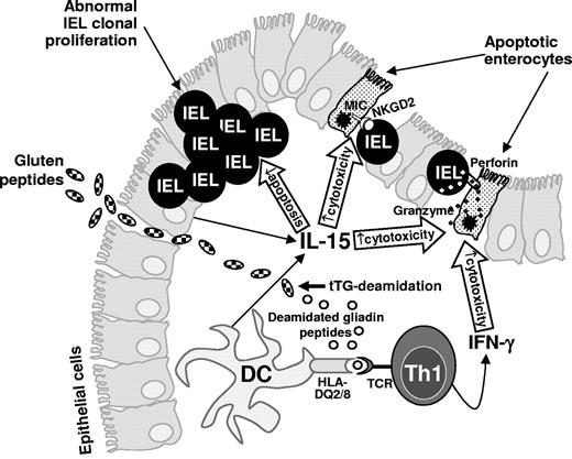 Figure 1. Schematic representation of IL-15 lymphomagenic action leading to the emergence of EATL in CD. In active CD mucosa, IL-15, mainly produced by epithelial cells and dendritic cells (DCs), which present tissue transglutaminase (tTG)–deamidated gluten peptides to T cells in the context of HLA-DQ2 or HLA-DQ8 molecules, promotes the IEL cytotoxicity against epithelial cells by activating the perforin/granzyme system and favoring the interaction between the homodimeric NK activating receptor NFG2D and the major histocompatibility complex class I–related ligands (MIC), thus leading to enterocyte apoptosis. In addition, IL-15 inhibits IEL apoptosis, thus favoring the emergence of neoplastic IEL clonal proliferations, leading to the development of EATL. Activated gluten-reactive T helper cell type 1 cells (Th1) produce high levels of the proinflammatory cytokine IFN-γ, which contributes to the mucosal damage by further activating the cytotoxicity of IELs against enterocytes.