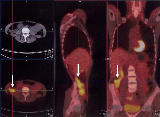 Figure 3. Features of EATL at PET scan. Intensely increased 18F-FDG-PET uptake areas (arrows) are evident on axial, sagittal, and coronal images of the small bowel of a patient with EATL.