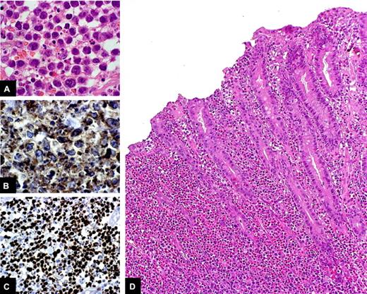 Figure 4. Histologic features of EATL. Medium-sized to large tumor cells with hyperchromatic nuclei, prominent nucleoli, and moderate to abundant, pale-staining cytoplasm, intermingled with eosinophils, are evident in the small bowel tissue specimen of a patient with EATL (A: H&E stain, original magnification ×100). The lesion is characterized by a considerable proportion of CD3-positive cells (B: CD3 immunostain, original magnification ×40) and a high proliferative rate (C: Ki-67 immunostain, original magnification ×40). At a lower magnification (D: H&E stain, original magnification ×20), it can be seen that the mucosa adjacent to the tumor shows histologic features of active CD, such as crypt hyperplasia, increased IEL infiltration, and villous atrophy.
