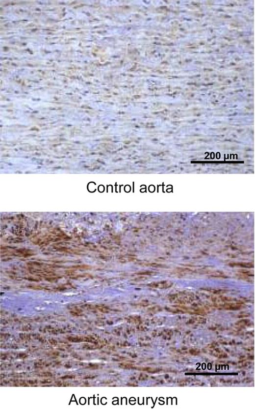 Figure 3. Immunohistochemical localization of PN-1 in human control aorta and thoracic aortic aneurysm. The immunostaining for PN-1 is diffuse throughout the medial layer in control aortas and largely increased in aortic aneurysm.