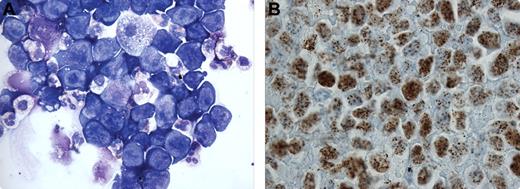 A 46-year-old man with HIV, not on HAART (highly active anti-retroviral therapy), presented with abdominal pain and urinary retention. A large, suprapubic mass and inguinal lymphadenopathy was palpated on examination. Laboratory data showed renal failure, hyperuricemia, anemia, and thrombocytopenia. CT scans showed bilateral hydronephrosis caused by a pelvic mass involving the bladder with caudal extension encasing the ureters bilaterally. There was diffuse retroperitonal, abdominal, and pelvic lymphadenopathy. / Fine needle aspirations of the inguinal nodes and pelvic mass were nondiagnostic. Wright-Giemsa stain of a urine cytospin specimen (panel A) showed large atypical cells with high nuclear:cytoplasmic ratio. The cells were negative for CD19, CD20, and CD79a on flow cytometry. Human herpesvirus-8 (HHV-8; panel B) and EBV stains on the inguinal lymph node were positive. A diagnosis of extracavitary primary effusion lymphoma (PEL) was made. / PEL is an HHV-8–associated illness seen in HIV, characterized by serous effusions usually without detectable tumor masses. The lymphoma cells are typically EBV and CD45 positive, but lack CD19, CD20, and CD79a. Typical histology combined with HHV-8 positivity in an immunocompromised host is pathognomonic for PEL. Unique to this case is the presentation of extracavitary tumors and use of flow cytometry on abnormal urine cytology as a means of diagnosis.