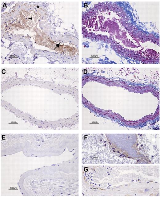 Figure 5. Immunohistochemical detection of sPLA2-V in sections of injured vessels with an attached thrombus. (A-D) Carotid artery sections of a mouse subjected to left carotid artery laser injury model. Rabbit anti–mouse sPLA2-V Ab (A,C) or Masson trichrome for fibrin detection (B,D) was used. (A) sPLA2-V was present in the injured carotid artery: in endothelial cells (arrow), neutrophils (arrowhead), vascular smooth muscle cells (*), and around fibrin in the lumen. (B) The soft purple staining in the lumen of the injured carotid artery revealed the presence of extensive fibrin deposits. (C) There was no sPLA2-V in the noninjured carotid artery. (D) Fibrin was not detected in the noninjured artery. (E-G) The presence of sPLA2-V was also studied in human left atrial tissue sections. (E) sPLA2-V was absent in the atrial sample of a patient in sinus rhythm. (F-G) sPLA2-V was detected around the fibrin thrombus and along the endothelial lining in the atrial section corresponding to a patient in atrial fibrillation. The microscope was a Nikon Eclipe 80i (Nikon Instruments Inc) equipped with a DXM1200F digital camera (Nikon). Panels A, B, and E through G were captured with a 40×/0.75 NA objective (Plan Fluor; Nikon). Panels C and D were captured with a 20×/0.50 NA objective (Plan Fluor; Nikon). All images were acquired using Nikon ACT-1 Version 2.63 software.