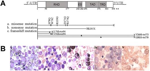 Figure 1. RUNX1 mutations in myeloid transformation of CML. (A) Summary of the 10 types of RUNX1 mutations in CML patients with acute transformation of CML analyzed in our study. Three categories of mutations were seen: missense mutations, nonsense mutations, and frameshift mutations. Arrowheads and vertical lines indicate the sites of mutation; X represents the site of the stop codon. ES indicates the Ear-2 binding site; UTR, untranslated region. (B) Morphological and histochemical investigation of BM samples from unique patient number 2 (UPN2) with RUNX1 H78Q. (Bi) Wright staining of BM cellular smear from patient UPN2 at CML-CP. (Bii-Bv) Examination on the BM samples from patient UPN2 at CML-BC: Wright staining (Bii); MPO staining, a specific marker of myeloid cells (Biii); periodic acid-Schiff staining (Biv); and naphthol AS-chloracetate esterase staining, a marker of granulocytes (Bv).