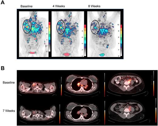 Figure 1. 18FDG-PET responses. (A) 18FDG-PET before and at 4 and 8 weeks after TDL. PN6, a 36-year-old with primary-refractory HL with unabated disease progression following myeloablative conditioning and a 6 of 6 HLA-matched sibling-donor AlloSCT with posttransplantation in vivo T-cell depletion with cyclophosphamide. Transient responses followed radiation and gemcitabine, vinorelbine, and liposomal doxorubicin therapies. Twenty-eight months post-AlloSCT, TDL were generated from a right axillary tumor harvest and 26.3 × 106 TDL/kg were infused. Moderate pain and tenderness at sites of chest wall tumor and worsening of pleural effusions developed 1 week after infusion. At restaging, 18FDG-PET-CT demonstrated decreasing standardize uptake values (SUV) in all lesions over 3 consecutive months. By 4 months, however, PET showed increasing SUV in prior sites of disease, which correlated with clinical progression. Shown are coronal maximum intensity projection (MIP) images with a cutoff intensity of 2.5 SUV. (B) Transverse 18FDG-PET-CT fusion images demonstrate decreased SUV in PN8, a 35-year-old with relapsed HL, whose disease progressed from best partial response 6 months after reduced-intensity conditioning and a T-cell replete, 6 of 6 HLA-matched sibling-donor AlloSCT. The patient was treated with vinblastine and subsequently with 3 cycles of dose-adjusted EPOCH (etoposide, vincristine, adriamycin, prednisone, and cyclophosphamide) plus DLI. Seventy months from AlloSCT, TDL were generated from a right axillary tumor harvest, and 91.2 × 106 TDL/kg were infused. Grade 2 cytokine release syndrome (culture-negative fevers to 39.5°C, mild hypotension, and tachycardia) was observed from 4 to 24 hours after infusion. 18FDG-PET-CT was stable at 4 weeks, then demonstrated decrease in SUV in multiple sites of disease at 2 months; tumor size was stable by CT. At 4 months, although PET-CT did not show clear progression, the patient developed severe radicular pain associated with tumor-involved cervical lymph nodes requiring additional therapy.