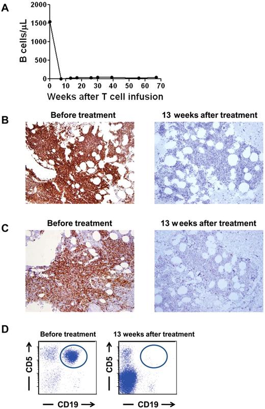 Figure 3. Normal and malignant B-lineage cells were eliminated from the blood and BM of patient 3. (A) Before treatment, the blood of patient 3 contained an elevated number of B cells, 96% of which were leukemia cells. After treatment, the blood B-cell count has remained below normal and patient 3 has been in complete remission for 67 weeks. B cells were quantitated by flow cytometry staining of CD19+ cells. (B) CD19 IHC staining of the BM of patient 3 is shown before treatment and 13 weeks after treatment. The BM contained large numbers of CD19+ cells before treatment. Thirteen weeks after treatment, CD19+ cells were nearly absent. (C) CD20 IHC staining of the BM of patient 3 is shown before treatment and 13 weeks after treatment. The BM contained large numbers of CD20+ cells before treatment. Thirteen weeks after treatment, CD20+ cells were nearly absent. (D) Flow cytometric results of a BM aspirate from patient 3 are shown. Plots are gated on lymphoid cells by forward and side scatter. A monoclonal population of B cells expressing the characteristic CD19+ and CD5+ phenotype of CLL (circled) was present before treatment but not 13 weeks after treatment.