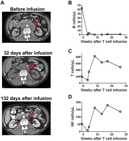 Figure 4. Patients receiving infusions of anti–CD19-CAR–transduced T cells had reductions in adenopathy and elimination of normal B cells. CT scans of patient 7 showed extensive adenopathy before treatment. This adenopathy regressed by day 32 after CAR-transduced T-cell infusion (arrow). The enlarged lymph nodes continued to substantially regress between 32 and 132 days after CAR-transduced T-cell infusion. (B) Patient 8 had a normal number of polyclonal blood B cells before treatment. B cells were eliminated from the blood after treatment and had not recovered 26 weeks after anti–CD19-CAR–transduced T-cell infusion. B cell counts were determined by flow cytometry for CD19 and confirmed by flow cytometry for CD20. In contrast to the B cells, blood T-cell counts (C) and NK-cell counts (D) rapidly recovered after treatment.