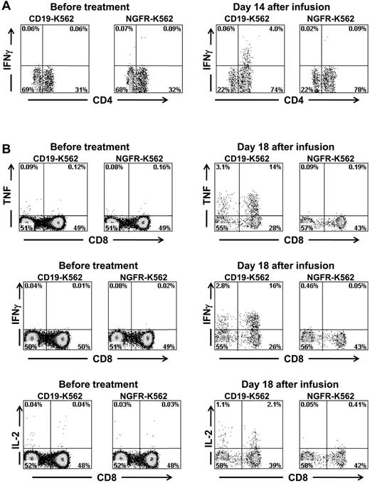 Figure 7. Large numbers of T cells producing cytokines in a CD19-specific manner can be detected in the blood of patients after anti–CD19-CAR–transduced T-cell infusions. (A) PBMCs were collected from patient 3, 14 days after infusion of CAR-transduced T cells. When the PBMCs were cultured for 6 hours with CD19-K562 cells that expressed CD19, a population of CD4+ cells that produced IFNγ was detected; in contrast, when the PBMCs were cultured with the control cells NGFR-K562 that lack CD19 expression, T cells did not produce IFNγ. PBMCs collected before the anti–CD19-CAR–transduced T-cell infusion did not produce IFNγ after incubation with either CD19-K562 or NGFR-K562. Plots are all gated on CD3+ lymphocytes. (B) PBMCs were collected from patient 7, 18 days after infusion of CAR-transduced T cells. When the PBMCs were cultured for 6 hours with CD19-K562 cells that expressed CD19, T cells that produced IFNγ, TNF, and IL-2 were detected. When the PBMCs were cultured with the control cells NGFR-K562 that lack CD19 expression, T cells did not produce IFNγ, TNF, or IL-2. PBMCs collected before the anti–CD19-CAR–transduced T-cell infusion did not produce IFNγ, TNF, or IL-2 after incubation with either CD19-K562 or NGFR-K562. Plots are all gated on CD3+ lymphocytes.