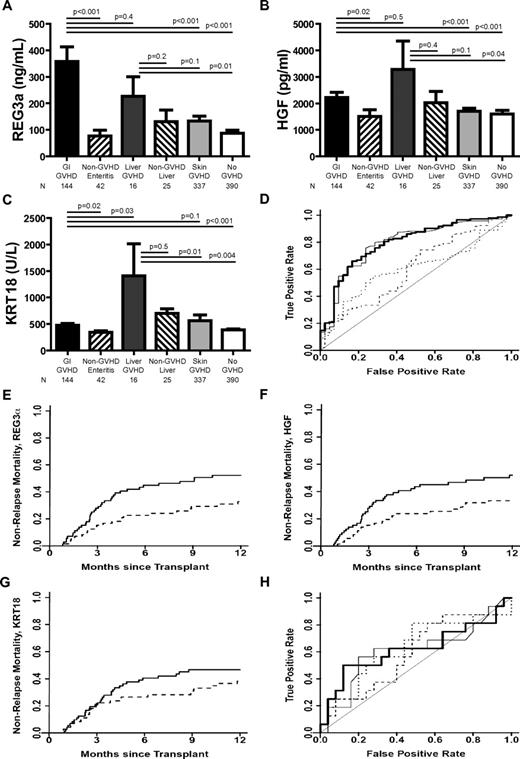Figure 1. Biomarkers at the onset of GVHD symptoms. (A-C) REG3α, HGF, and KRT18 concentrations, respectively, at the onset of symptoms consistent with GVHD in 954 HCT patients. (D) ROC curves comparing biomarker concentrations at the onset of LGI GVHD without liver GVHD (n = 144) and non-GVHD diarrhea (n = 42). REG3α (thin solid line): AUC = 0.79; HGF (dotted line): AUC = 0.60; KRT18 (dashed line): AUC = 0.60; composite of all 3 biomarkers (thick solid line): AUC = 0.80. (E-G) NRM in patients with LGI GVHD at onset with onset concentrations above the median (solid line; n = 89) versus patients with onset concentrations below the median (dotted line; n = 89) for REG3a, HGF, and KRT18, respectively. (E) REG3a: > 135 ng/mL versus ≤ 135 ng/mL; 52% versus 33%, P = .01. (F) HGF: > 1398 pg/mL versus ≤ 1398 pg/mL; 52% versus 33%, P = .02. (G) KRT18 > 373 U/L versus ≤ 373 U/L; 47% versus 38%, P = .3. (H) ROC curves comparing biomarker concentrations at the onset of liver GVHD without GI GVHD (n = 16) and non-GVHD liver complications (n = 25); REG3α (thin solid line): AUC = 0.61; HGF (dotted line): AUC = 0.59; KRT18 (dashed line): AUC = 0.63; composite of all 3 biomarkers (thick solid line): AUC = 0.62.