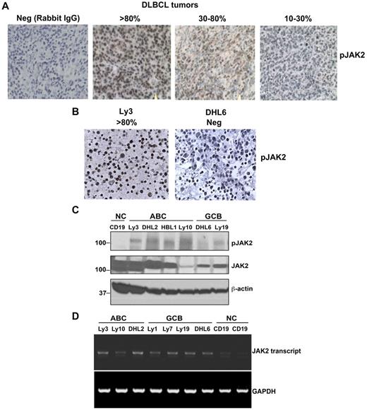 Figure 3. Constitutive activation of JAK2 in patient DLBCL tumors (n = 12) and cell lines. (A) IHC detection (400× magnification) of activated JAK2 protein in DLBCL tissue. (B) IHC detection of activated JAK2 in DLBCL cell lines. (C) Phosphorylation levels of JAK2 in human DLBCL cell lines (ABC and GCB) were analyzed by Western blotting. CD19+ B cells were used as a control. (D) JAK2 mRNA expression was analyzed in DLBCL lines by RT-PCR.