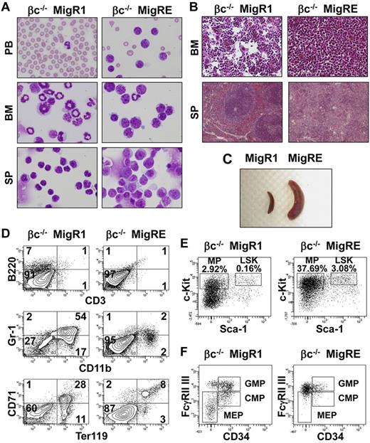 Figure 4. AML is observed in animals transplanted with βc−/− RUNX1-ETO cells. (A) Cytological analysis of a representative leukemic βc−/− MigRE animal. Peripheral blood (PB) smears, BM, and spleen (SP) cytospin samples stained with Wright-Giemsa are shown (original magnification, 400×). (B) Histopathological analysis of a representative leukemic βc−/− MigRE animal. H&E-stained sections of the BM (original magnification, 200×) and SP (original magnification, 100×) are shown. (C) Splenomegaly observed in leukemic βc−/− MigRE animal. (D) Flow cytometric analysis of the BM from a representative leukemic βc−/− MigRE animal; numbers represent percentage in GFP+BM cells. CD3/B220 are lymphocyte markers; CD11b/Gr-1, granulocyte markers; Ter119/CD71, erythroid markers. (E) Flow cytometric analysis of myeloid progenitor (MP) or LSK from a representative leukemic βc−/− MigRE animal. Respective percentages in GFP+BM are shown. (F) Flow cytometric analysis of MP populations from a representative leukemic βc−/− MigRE animal. CMP indicates common myeloid progenitor; GMP, granulocyte-macrophage progenitor; and MEP, megakaryocyte-erythrocyte progenitor.