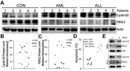 Figure 7. FBXL2 and cyclin D2 are differentially expressed in AML and ALL subjects. (A-C) PBMCs from 5 controls, AML, and ALL subjects were cultured in RMPI medium for 18 hours. Cells were then collected, lysed, and assayed for FBXL2 and cyclin D2 by immunoblotting (A). FBXL2 and cyclin D2 protein levels were quantified by densiometry using ImageJ Version 1.45 software, and the distribution of cyclin D2 (B) and FBLX2 protein (C) in each individual subject was graphed (n = 5, P < .005 vs control). (D) Leukemic cells were transfected with FBXL2 using a HVJ-E transfection kit for 24 hours. Cells were stained with annexin V and processed by flow cytometry. Apoptotic cells were quantified and graphed. (n = 5, P < .01 vs control). (E) FBXL2 and cyclin D2 protein levels were also analyzed from representative of AML and ALL transfected PBMCs.