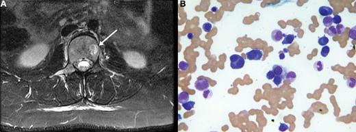 A 23-year-old female presented with progressive low back pain for several weeks. She had been diagnosed with dermatomyositis at the age of 3 and received corticosteroids episodically for 5 years until her rheumatologic condition achieved complete remission. Magnetic resonance imaging of the spine showed a T2 bright lesion (panel A) at multiple levels without evidence of cord compression. Laboratory findings included normocytic anemia of 9.2 g/dL, normal platelets and white blood cell count, β-2 microglobulin of 3.3 mg/L, normal calcium and creatinine. Serum electrophoresis revealed high levels of serum IgG (7970 mg/dL) characterized as IgG κ monoclonal protein. Urine protein electrophoresis showed 7.6 mg/dL of IgG κ monoclonal protein. Bone marrow biopsy and aspirate (panel B) showed a hypercellular marrow with 43% infiltration of plasma cells. A diagnosis of IgG κ multiple myeloma was made and treatment was started with lenalidomide, bortezomib, and dexamethasone. An autologous bone marrow transplantation is planned. / This case highlights the value of clinical assessment. Multiple myeloma is infrequently seen in patients under the age of 30 and dermatomyositis is a disease known to be associated with malignancies. Few cases reported in the literature describe paraneoplastic dermatomyositis associated with pre-existent multiple myeloma. This very young patient developed multiple myeloma associated with pre-existent dermatomyositis. The precise relationship between dermatomyositis and myeloma is unknown.