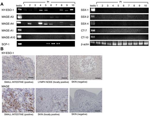 Figure 1. NY-ESO-1, MAGE-A3, and MAGE-A4 are widely expressed by primary ATLL cells. (A) Representative results of RT-PCR analysis for mRNA expression of NY-ESO-1, MAGE-A1, MAGE-A3, MAGE-A4, MAGE-A10, CT-7, CT-10, SSX-1, SSX-2, SSX-4, and SCP-1. (B) ATLL samples were subjected to immunohistochemical staining for NY-ESO-1 (E978) mAb and pan-MAGE (57B) mAb. Bar represents 50 μm. These experiments were performed independently at least twice with similar results.