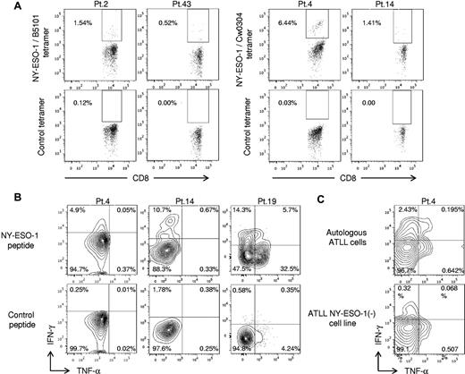 Figure 3. NY-ESO-1–specific CD8+ T cells are detected in ATLL patients. CD8+ T cells derived from PBMCs of patients 1, 2, 4, 8, 13, 14, 19, 27, and 43 were presensitized by CD4− CD8− PBMCs pulsed with NY-ESO-1 peptides covering the entire sequence of NY-ESO-1 as described in “In vitro sensitization.” (A) Induction of specific CD8+ T cells was analyzed by staining with NY-ESO-1/HLA tetramers indicated. Cytokine (IFN-γ and TNF-α) secreting capacity of NY-ESO-1–specific CD8+ T cells was analyzed by intracellular cytokine staining for recognition of (B) autologous activated T-cell APCs pulsed with NY-ESO-1 peptides or (C) autologous ATLL cells. These experiments were performed independently at least twice with similar results.