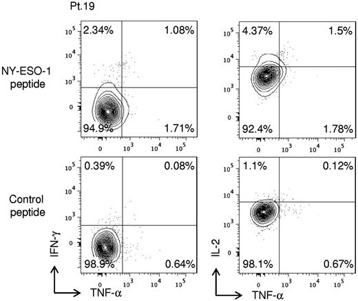 Figure 4. NY-ESO-1–specific CD4+ T cells are present in an ATLL patient (patient 19) receiving an allogeneic hematopoietic stem cell transplantation. CD4+ T cells were presensitized by CD4− CD8− PBMCs pulsed with NY-ESO-1 peptide covering the entire sequence of NY-ESO-1 as described in “In vitro sensitization.” Induction of NY-ESO-1–specific CD4+ T cells was analyzed by intracellular cytokine staining using autologous activated T-cell APCs pulsed with NY-ESO-1 peptides. These experiments were performed independently twice with similar results.