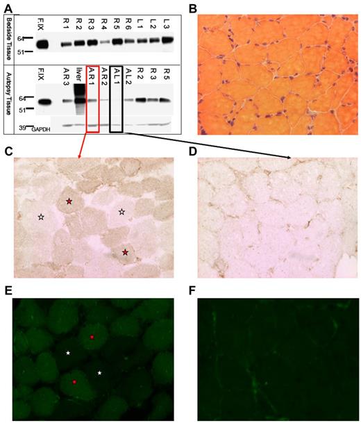 Figure 1. Evidence of F.IX protein in subject F muscle. (A) Western blot for human F.IX on protein extracted from tissue removed at bedside on patient expiry (top half) and at autopsy (bottom half); A indicates autopsy; R, right leg; L, left leg; F.IX, Benefix recombinant hF.IX control. (B) H&E stain of patient-injected muscle showing normal histology. (C-D) F.IX IHC of strongly F.IX-positive (C, same sample boxed in red from panel A) and very weakly positive (D, same sample boxed in black from panel A) tissue sections of injected patient muscle. (C-F) Magnification: ×20; red stars indicate F.IX-expressing muscle fibers; and white stars, no F.IX production. (E-F) F.IX IF of strongly F.IX-positive (E, same sample boxed in red from panel A) and very weakly positive (F, same sample boxed in black from panel A) sections of injected patient muscle.