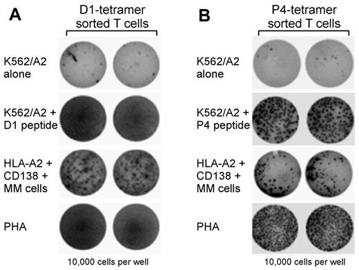 Figure 7. D1- and P4-specific CD8 T cells recognize primary MM tissue from HLA-A2–positive patients. Sorted D1- or P4-positive CD8 T cells were tested by ELISpot against MM BMMCs isolated from fresh BM from HLA-A2–positive donors. D1-specific (A) and P4-specific (B) T cells recognized primary MM BMMCs from HLA-A2–positive donors (n = 5), but not healthy HLA-A2–positive BMMCs (n = 2) or HLA-A2–negative MM BMMCs (n = 4).