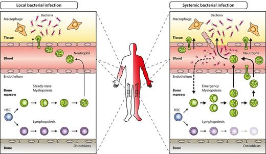Figure 1. Key hematopoietic differences in local versus systemic bacterial infection. Local bacterial infection leads to activation of resident hematopoietic cells (eg, macrophages) as well as nonhematopoietic cells (eg, parenchymal, vascular, or stromal cells), and to subsequent release of inflammatory cytokines and chemokines. As a net result, myeloid effector cells are attracted to the site of infection, where they exert their antimicrobial functions under the influence of locally produced cytokines. Apart from local signs of infection (calor, dolor, rubor, tumor, and functio laesa), no systemic effects such as peripheral blood leukocytosis or left-shift are induced (left). By contrast, locally noncontrolled infection (eg, sepsis) leads to systemic symptoms such as fever, peripheral blood leukocytosis, and left-shift. Concomitantly, BM myelopoiesis is massively enhanced above steady-state levels (emergency myelopoiesis) to provide myeloid effector cells needed to resolve the infection (right).