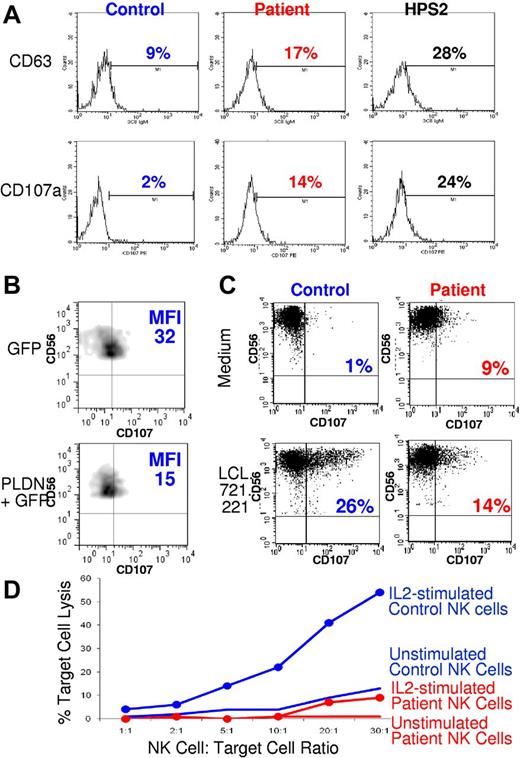 Figure 1. Effects of a PLDN mutation on NK-cell function. (A) Histograms of flow cytometric measurement of CD63 and CD107a on IL-2–activated NK cells from a normal control subject, the pallidin-deficient patient, and a patient with HPS2. (B) Two-color flow cytometric measurement of CD107a and CD56 on IL-2–activated NK cells from the pallidin-deficient patient, after transfection with expression vectors containing GFP or PLDN and GFP. (C) Two-color flow cytometric measurement of CD107a on IL-2 activated NK cells from a normal control subject and the pallidin-deficient patient, after culture with medium or with target cell line LCL.721.221. (D) Lysis of K562 NK target cells by freshly isolated PBMCs from the pallidin-deficient patient and a healthy control before and after overnight incubation with IL-2. Experiments were repeated 3 times in 3 independent experiments.