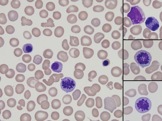 A male neonate was born at 28 weeks of gestational age by C-section because of intrauterine growth restriction and fetal anomalies. Radiographic scans showed cardiomegaly, pleural effusion, and ascites, consistent with hydrops fetalis. He developed a disseminated rash, respiratory failure, anemia, and thrombocytopenia. A complete blood count showed corrected white blood cell count 9.3 × 109/L, hemoglobin 112 g/L, platelets 16 × 109/L, MCV 139.1 fL (normocytic for gestational age), and 353 nucleated red blood cells per 100 white blood cells counted. Morphologic examination of the peripheral blood noted erythroid precursors at every stage of development, as well as a few circulating mitotic figures (see photos). An evaluation for hemolytic disease of the newborn (HDN) was negative. / The baby died 1 day after birth because of extreme prematurity and hyaline membrane disease despite maximal respiratory support. Viral culture of the amniotic fluid was positive for cytomegalovirus (CMV). Autopsy findings confirmed widespread CMV infection, suggestive of CMV-associated hydrops fetalis. / CMV is a common cause of congenital infections, and is associated with extensive neurodevelopmental morbidity in newborns. However, hydrops fetalis is a rare complication of CMV.