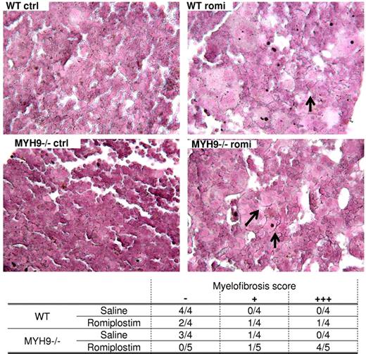 Figure 7. Myosin-deficiency increased myelofibrosis induced by romiplostim. Histologic sections stained for reticulin fibers (appearing black, arrows) showing the absence of fibrosis in control WT or Myh9−/− BM, compared with the presence of fibrosis after 1 month of romiplostim treatment. Quantification was performed according to the absence of fibers (−), presence of a few fibers (+), or presence of numerous fibers (+++). Fibrosis was more extensive in Myh9−/− mice. Similar data were obtained with a second series of animals treated with the same romiplostim protocol (not shown).