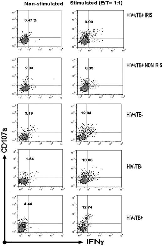 Figure 2. Flow cytometric analysis of NK-degranulation capacity. A typical pattern of CD107a expression and IFN-γ production is shown for unstimulated and K562 cell–stimulated PBMCs from the indicated groups. Dot plots are gated on NK cells. The percentage of total CD107a expression on NK cells is indicated.