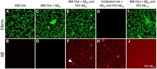 Figure 5. Confocal microscopy of fibrin clots show Aβ binding to fibrin fibrils. Fibrin clots were formed with or without Aβ42 as described in “Aβ binding to fibrin(ogen)” to determine the location of Aβ binding. (Top row) Fibrin visualized with Alexa Fluor 488–labeled fibrinogen (green); (bottom row) Aβ visualized with HiLyte Fluor 555–labeled Aβ (red); (A-B) control clot. (C-D) Clot with only unlabeled Aβ42 shows that fibrin fibers and irregular clusters do not produce signal in the red channel. (E-F) Clot formed with unlabeled Aβ42 and HiLyte Fluor 555–labeled Aβ42 shows colocalization between Aβ and fibrin fibers as well as Aβ and irregular clusters (arrowhead). (G-H) Clot formed without Alexa Fluor 488–labeled fibrinogen but with both unlabeled and labeled Aβ42 shows Aβ signal in the fibrin fiber pattern, confirming that Aβ signal is not Alexa Fluor 488 signal detected in the red channel. (I-J) Clot formed with unlabeled Aβ42 and HiLyte Fluor-555–labeled Aβ1-9 does not have Aβ signal along fibrin fibers or in aggregates, indicating that the Aβ42 signal represents specific Aβ-fibrin(ogen) binding and not fluorophore entrapment. Images are representative of ≥ 3 experiments.