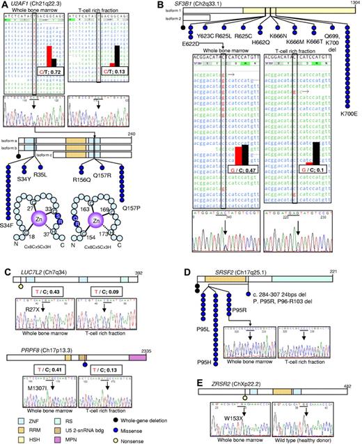 Figure 1. Somatic spliceosomal gene (U2AF1, SF3B1, SRSF2, LUC7L2, PRPF8, and ZRSR2) mutations as detected by next-generation sequencing (NGS) and Sanger sequencing technologies. (A) With the use of an NGS-based whole exome sequencing analysis of whole BM DNA from a patient with refractory cytopenia with unilineage dysplasia (left), a mutation of U2AF1 (21q22.3) at position 44 514 777 (T > C) was detected in 13 of 18 reads. Analysis of DNA from CD3+ cells showed a much lower frequency of the base change (2 of 15 reads; right), highlighting the somatic nature of this alteration. The finding was confirmed by Sanger sequencing. Arrows and bars indicate the specific nucleotide and predicted codon, respectively. It should be noted that U2AF1 is expressed from the minus strand; therefore, the NGS presentation (top panels) is complementally reversed in comparison to the Sanger sequencing results (middle panels). This heterozygous somatic mutation results in the predicted nucleotide change 470 A > G in exon 6 of the coding region, which lead to the amino acid change Q157R in the second zinc finger domain. In the entire cohort, 27 mutations were observed in 26 patients, including a whole gene deletion. All 26 missense mutations were located in 1 of the 2 zinc finger domains (ZNFs); 2 residues, S34 or Q157, were frequently affected (bottom panels). RRM indicates RNA recognition motif. (B) With the use of an NGS analysis of a patient with CMML (middle left), a mutation of SF3B1 (2q33.1) at position 198 267 491(C > G) was detected in 9 of 24 reads. The somatic nature of this alteration was confirmed by an analogous analysis of the CD3+ fraction, with the change being less frequent (2 of 23; middle right). The mutation was confirmed by Sanger sequencing (bottom). This heterozygous somatic mutation results in the nucleotide change 1866 G > T in exon 14 of SF3B1, resulting in the amino acid change E622D in the HSH155 domain. Analysis of the entire cohort identified mutations in 33 patients, including a case with a whole gene deletion. (C) Further screening by NGS led to the detection of a nonsense mutation (R27X) in LUC7L2 (7q34; top) which participates in the recognition of splice donor sites in association with the U1 snRNP spliceosomal subunit, and a missense mutation (M1307I) in PRPF8 (17p13.3; bottom) which is a large U5 snRNP-specific protein essential for pre-mRNA splicing. RS indicates serine/arginine-rich domain; U5 2-snRNA bdg, U5-snRNA binding site 2; and MPN, Mpr1p, Pad1p N-terminal domain. (D) Mutations of SRSF2, an arginine/serine-rich splicing factor, were detected in 29 cases among the entire cohort, including 2 whole gene deletions and a microdeletion within the gene (top). All mutations were heterozygous and affected P95. The somatic nature of the P95R mutation was confirmed with whole BM and T-cell rich fraction DNAs (bottom). (E) A nonsense mutation (W153X) was found in ZRSR2, another arginine/serine-rich splicing regulatory factor, in a case of CMML. ZRSR2 is located at Xp22.2, and the nonsense mutation was hemizygous in this male case (BM).