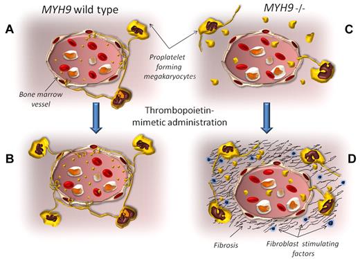 In normal conditions, proplatelet-forming megakaryocytes release nascent platelet directly in the bloodstream (A). Thrombopoietic stimulating agents expand the megakaryocyte pool and increase platelet production and release (B). The MYH9−/− mice replicate the megakaryocyte and platelet abnormalities observed in patients with MYH9-related diseases. The proplatelet formation occurs distant from vessels, with consequent platelet release inside the bone marrow environment. Only a few giant platelets are released in the bloodstream (C). When romiplostin is administered to these animals, the MYH9−/− megakaryocyte pool expands, and it can be hypothesized that the release of giant platelets inside the bone marrow is boosted. As a result, several growth factors for fibroblasts are secreted from platelets into the environment (including transforming growth factor-β, basic fibroblast growth factor, and platelet-derived growth factor), inducing the progressive bone marrow fibrosis (D).