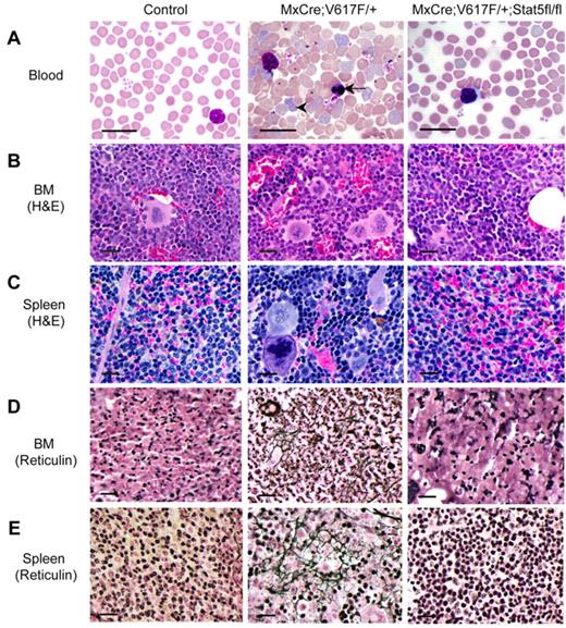 Figure 2. Histopathologic analysis. (A) Blood smears show decreased RBCs, leukocytes, and PLTs in induced MxCre;Jak2V617F/+;Stat5fl/fl mice compared with MxCre; Jak2V617F/+ mice. Arrows point to reticulocyte and nucleated immature RBC. (B) BM sections from induced MxCre;Jak2V617F/+ mice display hypercellularity with trilineage hyperplasia. In contrast, BM sections from induced MxCre;Jak2V617F/+;Stat5fl/fl mice are indistinguishable from the control BM. (C) Spleen sections from induced MxCre;Jak2V617F/+ mice exhibited a marked expansion of red pulp with clusters of megakaryocytes and immature erythroid progenitors. Noticeably, spleens from induced MxCre;Jak2V617F/+;Stat5fl/fl mice were normal and identical to control spleens. Reticulin staining on the BM (D) and spleen (E) sections showed fibrosis in the BM and red pulp of the spleens of older Jak2V617F knockin mice (24 weeks after induction), whereas Stat5-deficiency prevented the development of fibrosis in the BM and spleens of MxCre;Jak2V617F/+;Stat5fl/fl mice. Scale bars represent 20 μm in all images.