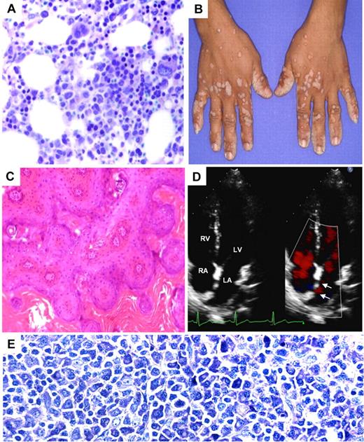 Figure 1. Clinical phenotype of STK4-deficient patients. (A) H&E-stained bone marrow biopsy shows mild increase in cellularity and full maturation of neutrophil granulocytes. (B) The photograph shows disseminated warts infections in P2. (C) H&E-stained sections from wart biopsy shows orthokeratotic verrucosis and epithelial hyperplasia (P2; original magnification ×100). (D) Echocardiogram (P1) showing atrial septal defect type II (arrow) and left-right shunt. RA indicates right atrium; LA, left atrium; RV, right ventricle; and LV, left ventricle. (E) Giemsa staining of the enlarged inguinal lymph node of P3, showing accumulation of plasmacytoid differentiated cells (original magnification ×400).