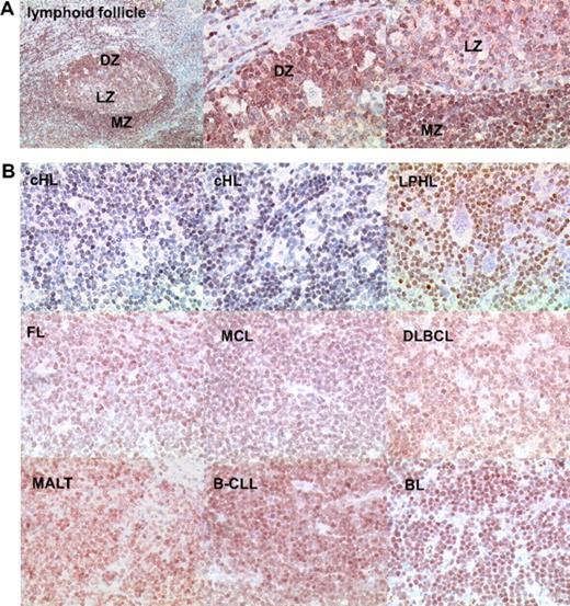 Figure 1. FOXO1 expression in lymphoid FL, HL, and NHL. (A) FOXO1 expression in tonsillar lymphoid follicle. Low magnification image represents immunohistochemical staining of FOXO1 distribution in the whole follicle (original magnification ×50). High-magnification images show FOXO1 expression in cells of dark zone containing centroblasts (DZ) and light and marginal zone containing centrocytes and resting B cells, respectively (LZ and MZ; original magnification ×200). (B) FOXO1 expression in BCLs. Neoplastic cells of cHL and LPHL are FOXO1-negative (original magnification ×200). Objective: Plan-Neofluar 10×/0.3 NA for the low magnification of normal lymphoid follicle and Plan-Neofluar 40×/0.75 NA objective for the high magnification normal lymphoid follicle and lymphoma images.