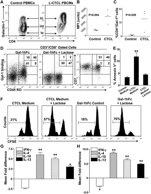 Figure 2. Gal-1 secreted from L-CTCL cells dampens T-cell proliferation and promotes Th2 cytokine skewing. (A) Intracellular Gal-1 expression in Th cells from patients with L-CTCL or healthy controls (n = 3/group) was analyzed by flow cytometry and presented as a contour plot. Arrows indicate Gal-1 high, intermediate, and low (“lo”) populations. (B) Graphical representation of intracellular Gal-1 levels quantified by mean fluorescence intensity (MFI). Statistically significant difference compared with healthy controls using Student paired t test. (C) Graphical representation of Gal-1hi Th cells in stage 4 CTCL patients or healthy controls. Statistically significant difference compared with healthy controls using Student paired t test. (D) PBMCs from healthy donors were gated on CD8+, and expression of Gal-1 ligands (Gal-1hFc binding) on CD45RO+ memory cells was determined by flow cytometry. Coexpression of CD7 in CD45RO+/− CD8+ T cells was also analyzed. Representative plots are shown. (E) Activated T cells from healthy donors (n = 3) were incubated with conditioned medium from primary L-CTCL cultures (with or without lactose) for 24 hours and then analyzed for annexin V binding. Statistically significant difference compared with lactose-treated control using Student paired t test: **P ≤ .001. (F) Alternatively, activated T cells were labeled with CFSE, incubated with L-CTCL–conditioned medium (with or without lactose) or with 0.25μM Gal-1hFc (with or without lactose) for 3 days, and CFSE dilution was analyzed by flow cytometry. Activated T cells from healthy donors (n = 3) were incubated with conditioned medium from primary L-CTCL cell cultures (with or without lactose; G) or with 0.25μM Gal-1hFc (with or without lactose; H) for 24 hours and then stained and analyzed for CD3 and intracellular IFN-γ, IL-4, IL-10, and IL-13. All experiments were performed with L-CTCL–conditioned medium from 3 different donors and performed in triplicate. Statistically significant difference compared with lactose-treated control using Student paired t test: *P ≤ .05, **P ≤ .001.