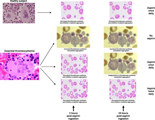 In vivo aspirin effect at peak and trough time points in healthy subjects and in patients with essential thrombocythemia receiving aspirin once or twice daily.