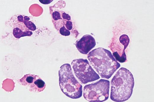 A 7-year-old boy with no prior illness or altered immunity presented to the emergency department with a 36-hour history of fever (103.7°F), emesis, headache, and lethargy. The patient had a history of swimming in a local lake the week before presentation. Physical examination revealed nuchal rigidity. Computed tomography (CT) of the head was normal. A lumbar puncture revealed a cerebrospinal fluid (CSF) protein of 670 mg/dL, glucose of 23 mg/dL, 265 red blood cells/mm3, and 308 white blood cells/mm3. The Giemsa-stained differential consisted of 54% polymorphonuclear leukocytes, 4% bands, 39% lymphocytes, and 1% monocytes. Numerous organisms were also identified that were consistent with Naegleria fowleri. Wet-mount preparation of fresh CSF confirmed the organism's characteristic swift motility. CSF culture and real-time PCR testing (Centers for Disease Control and Prevention) were positive for Naegleria fowleri and excluded Entamoeba histolytica. Follow-up CT scans demonstrated evidence of necrosis and cerebral edema. The patient was treated with amphotericin B, miltefocine, rifampin, fluconazole, and azithromycin but died on the ninth day of hospitalization. No autopsy was performed. / Naegleria fowleri meningoencephalitis is a rare, rapidly fatal amebic meningoencephalitis that occurs after swimming or diving in warm bodies of fresh water. There is no effective treatment and the fatality rate is more than 95%, with few known survivors.