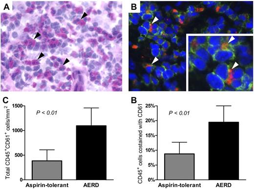 Figure 1. Detection of platelet-leukocyte aggregates in nasal polyp tissue. (A) H&E staining of nasal polyp tissue from a subject with AERD shows many eosinophils (black arrowheads). (B) Immunofluorescent staining of the same tissue shows leukocytes (green, CD45+) with adherent platelets (red, CD61+; white arrowheads). Photographs are shown at 400× magnification. (C) Total numbers of CD45+ cells that colocalized with CD61. (D) Percentages of CD45+ cells that colocalized with CD61 in the nasal polyp tissue from aspirin-tolerant controls with sinusitis (n = 4) and subjects with AERD (n = 6). Data are expressed as mean + SD.
